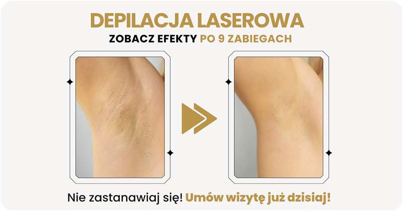 Depilacja laserowa efekty - trwałe usunięcie włosów laserem diodowym Luboń Poznań